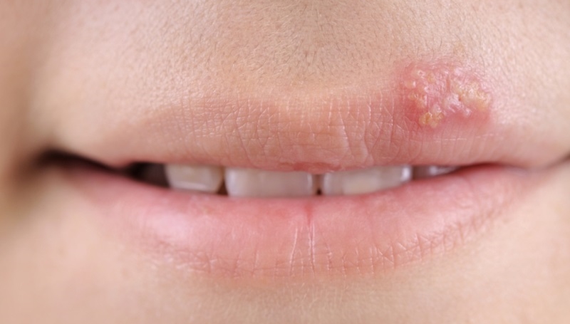 โรคเริม ที่ปาก เกิดจากอะไร มีวิธีดูแลรักษา และป้องกันอย่างไร?